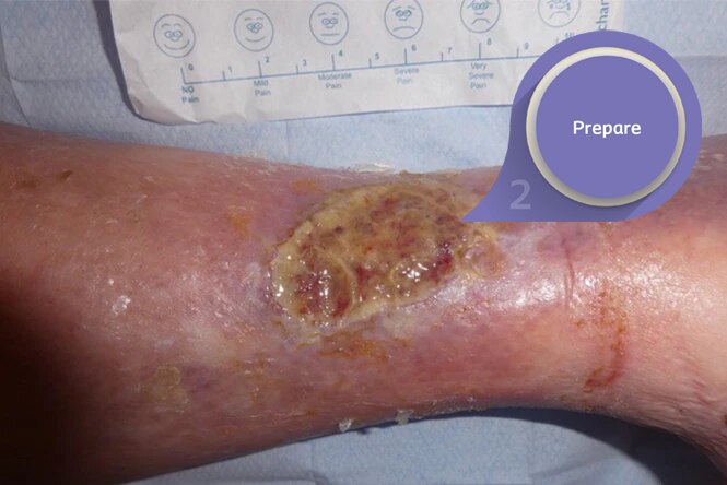 Wound bed preparation