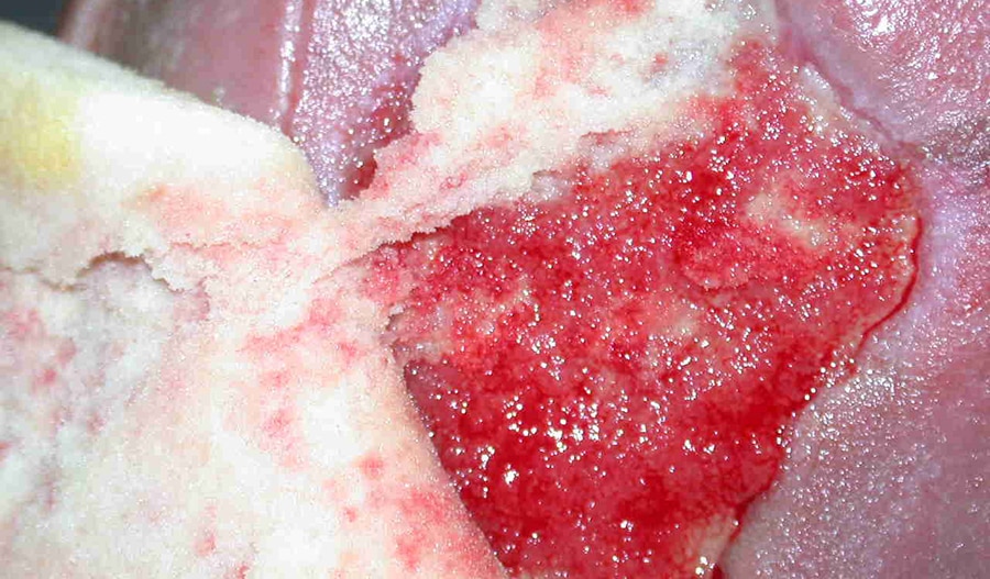 Moist Wound Healing