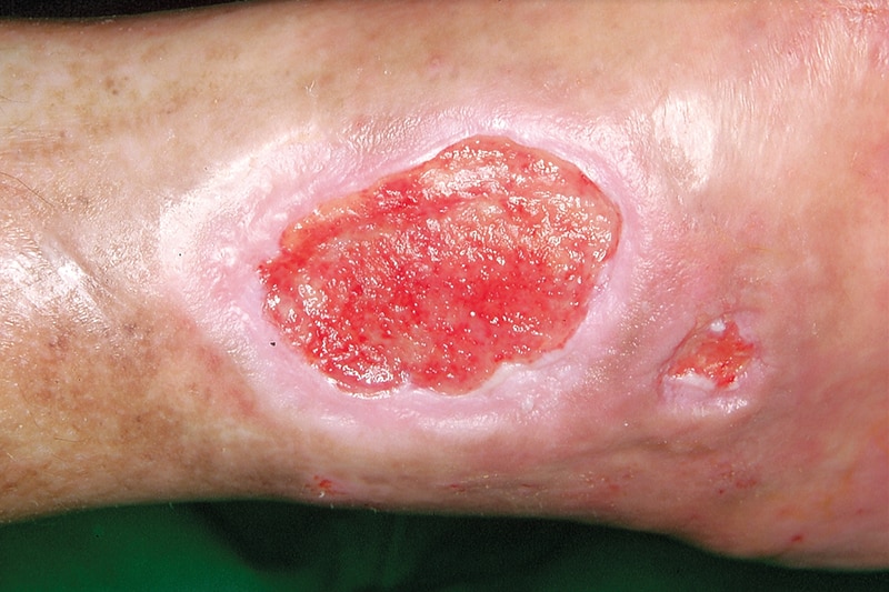 The role of the skin in wound healing