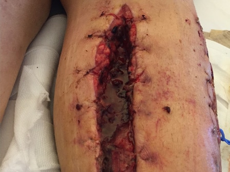 What is an acute wound?