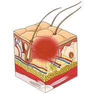 Stage 1 pressure ulcer