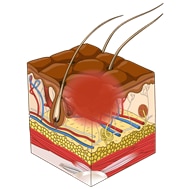 Stage 2 Pressure Ulcer