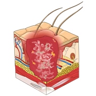 Stage-4 pressure ulcer