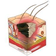 Unstageable pressure ulcer