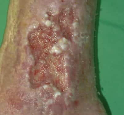 Venous leg ulcer on the lower leg