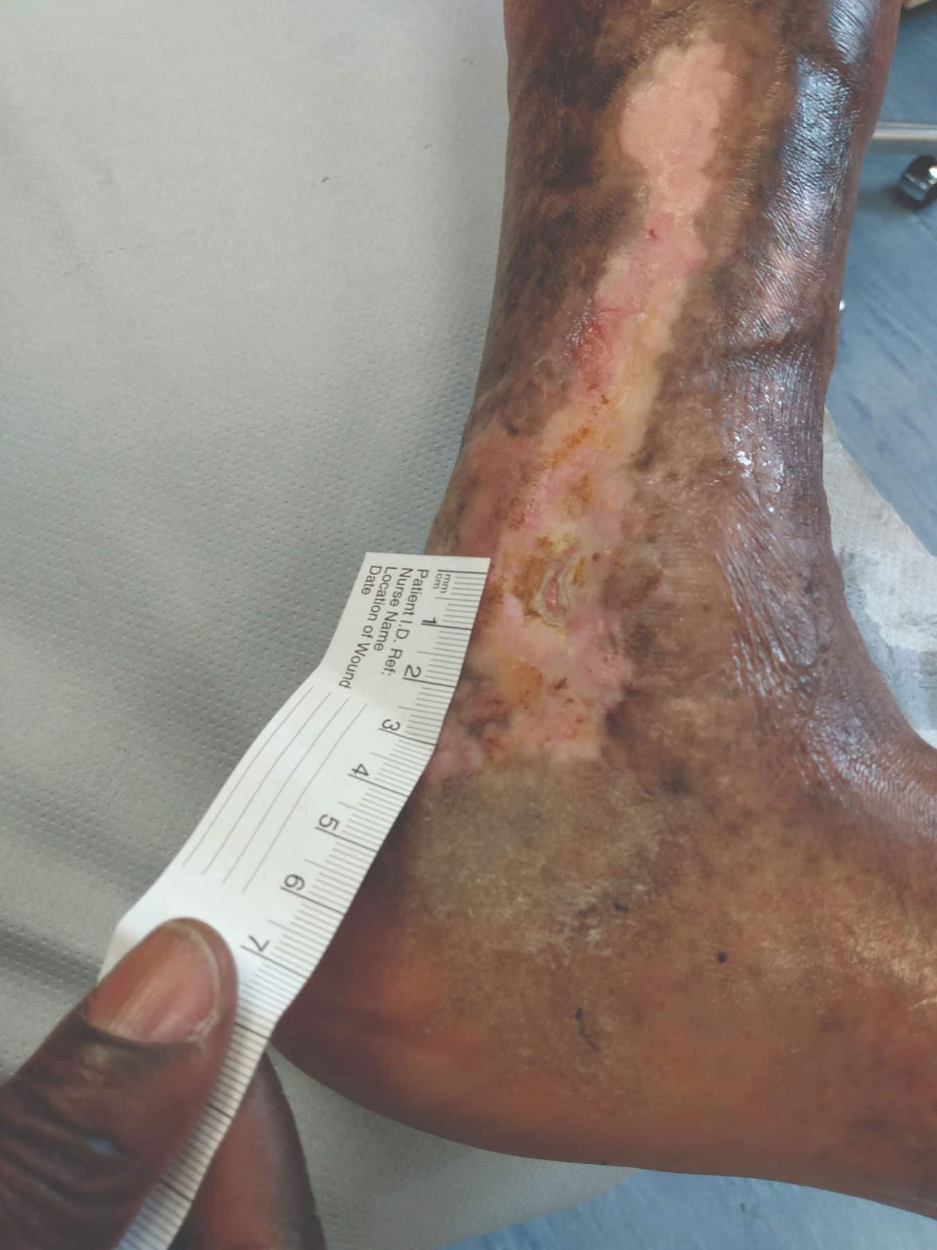 Venous leg ulcer on the lower leg