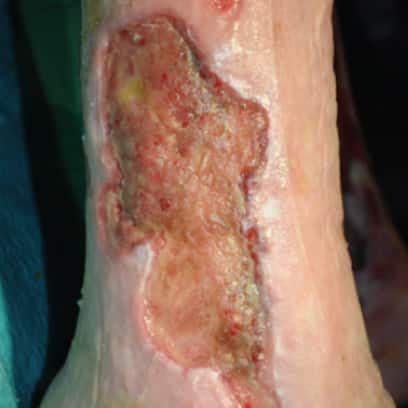 Venous leg ulcer on the lower leg